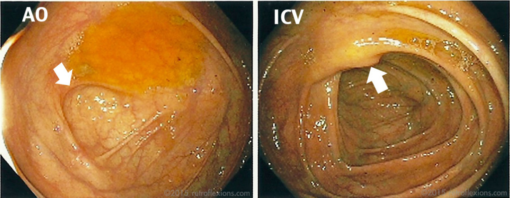AO: appendiceal orifice; ICV: Ileocecal valve