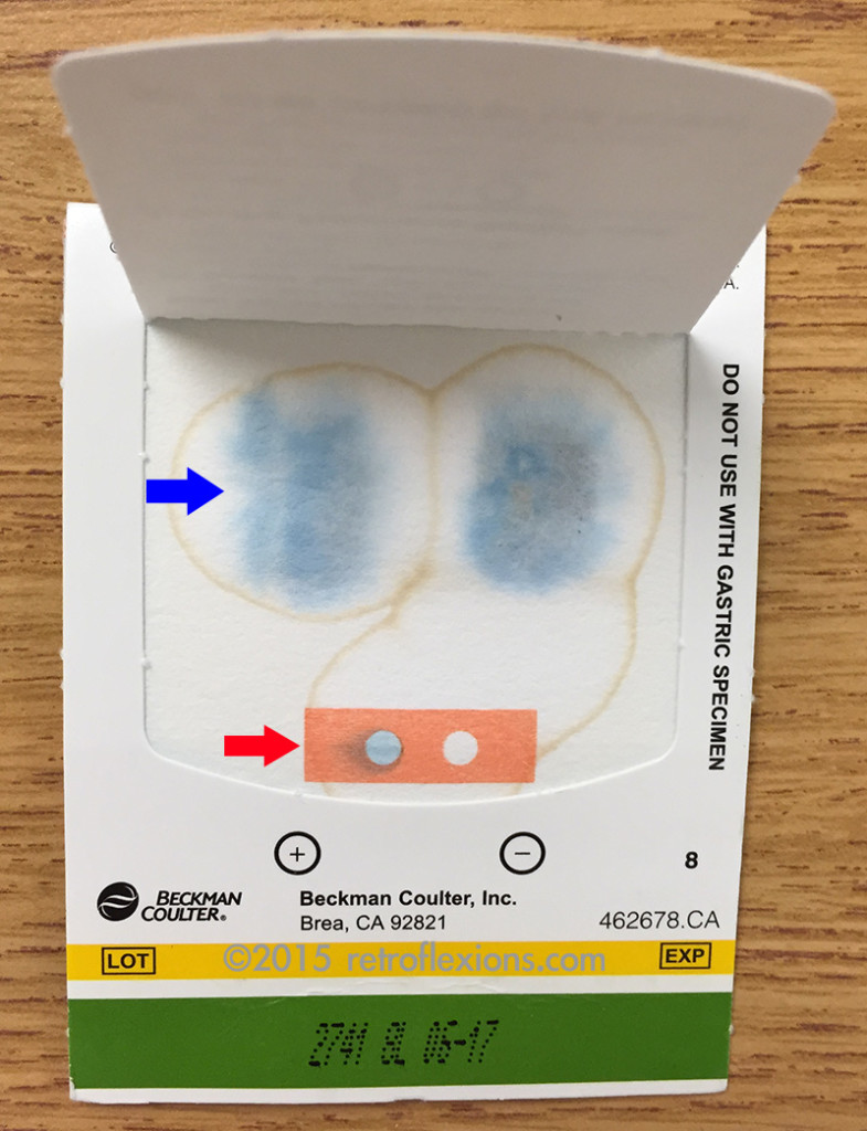 This is a positive stool guaiac test. The blue arrow shows the test pane. The blue color is the positive reaction from the presence of blood in the stool specimen, which is placed on the other side of the card. The red arrow shows the control pane. This shows that the test is working properly (i.e., the positive is blue and the negative is unchanged.) 
