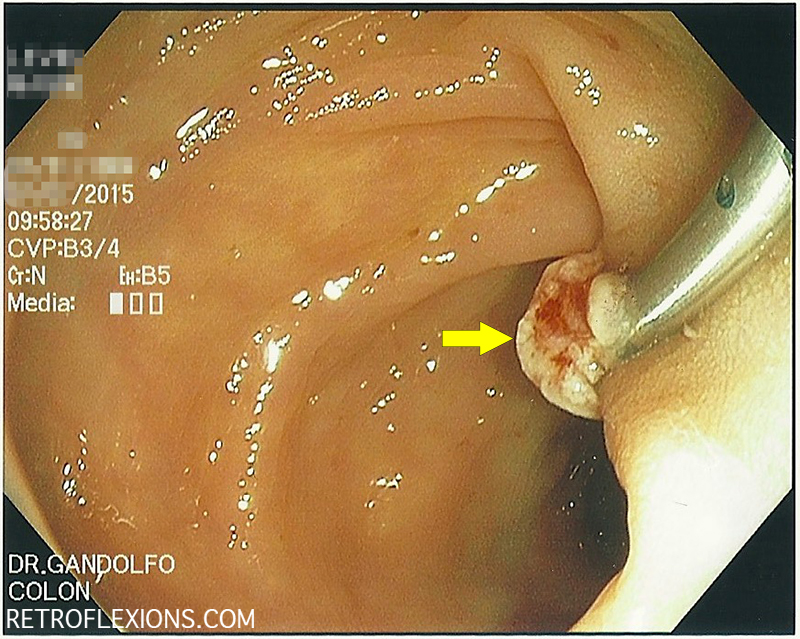Polyp site after resection. A clip is seen at the base of the polyp (yellow arrow shows the transected stalk.) Pathology revealed a tubulovillous adenoma.