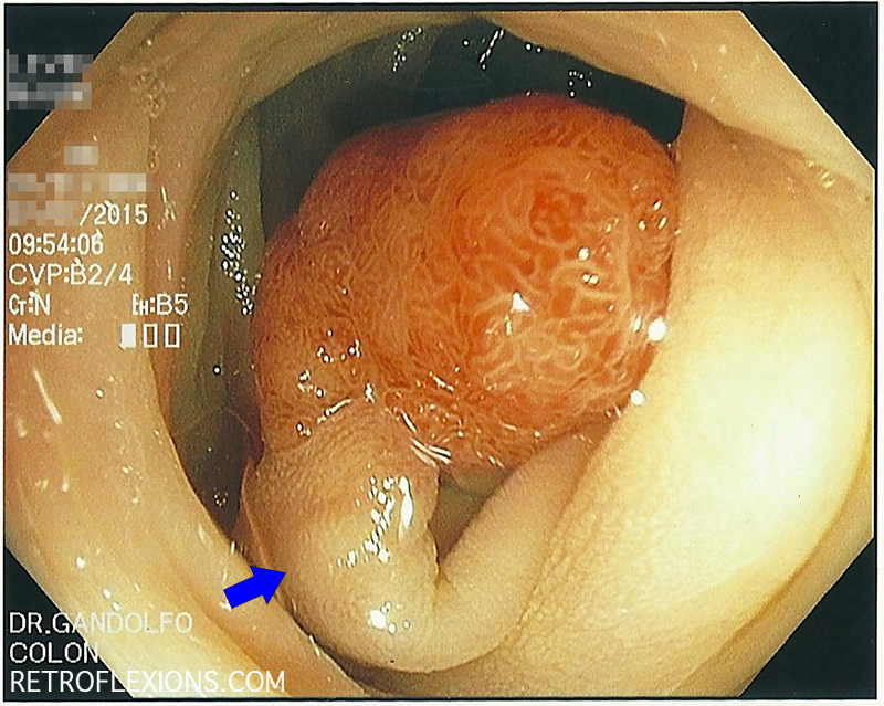 Large pedunculated polyp found in the sigmoid colon. Blue arrow shows the stalk.