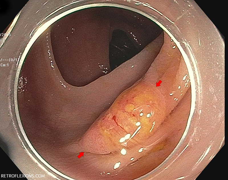 Flat ulcerated lesion (between red arrows) in the transverse colon showing the 'mucous cap' sign.