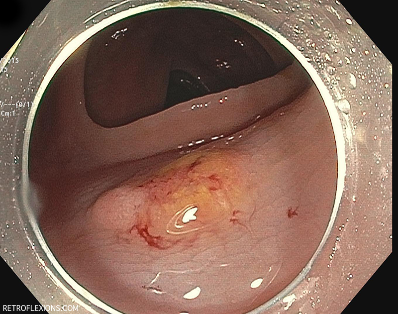 After saline injection the lesion becomes even flatter.