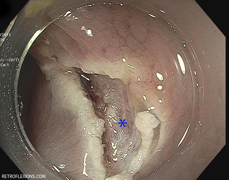 The base of the lesion (blue asterisk) after EMR.