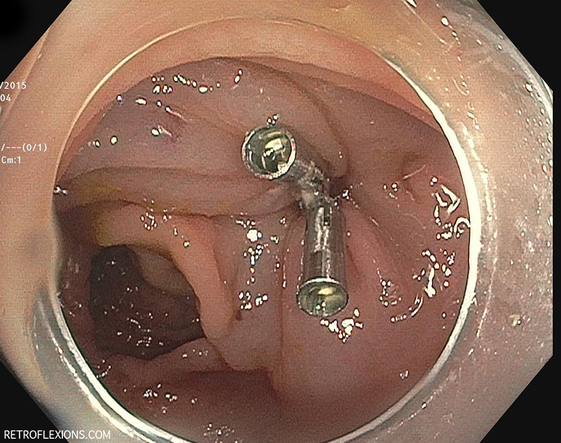 The appearance after the mucosal defect is closed with clips.