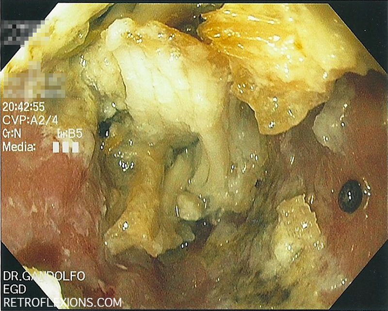 Meat (pork) fibers are visible on endoscopy in this case of food impaction.