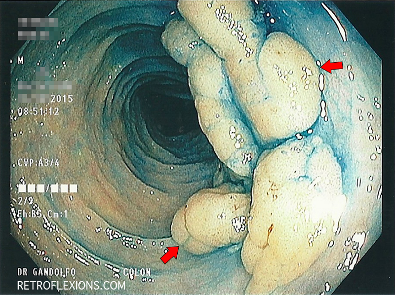 After spraying the lesion with methylene blue dye, the edges of the polyp are more apparent (red arrows show the edges of the lesion).