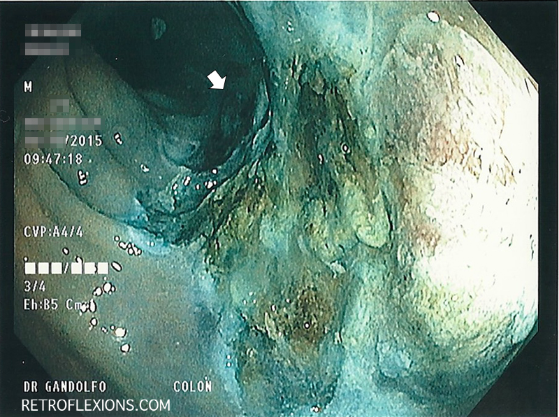 The appearance of the site after removal of the polyp. The white arrow shows the proximal-most edge of the resection.