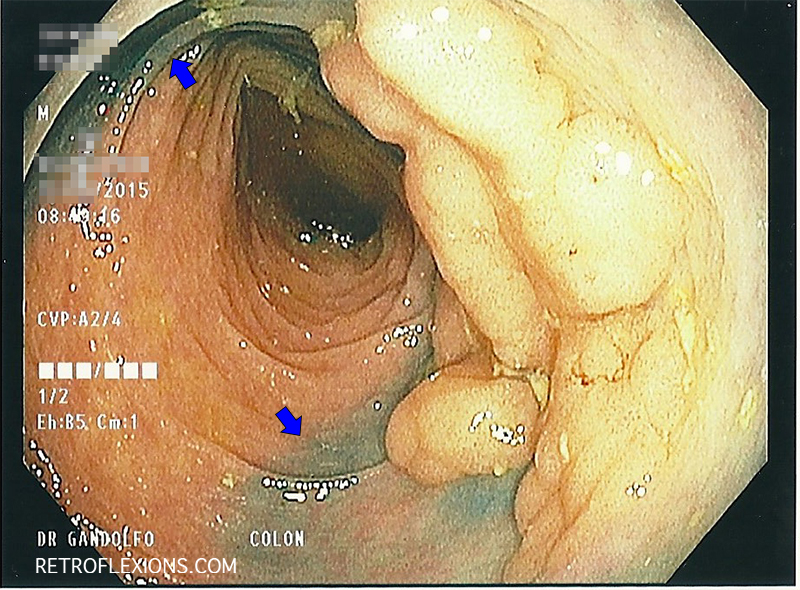Large polyp in transverse colon. Blue arrows denote tattoo marks left by referring doctor. Note that the tattoo mark extends to the edge of the polyp (and below the polyp).
