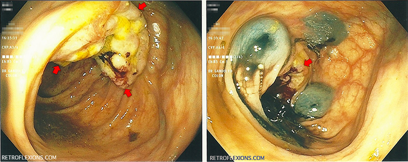 (L): ulcerated colon mass (adenocarcinoma) near the hepatic flexure. Red arrows show the edges of the mass; (R): Appearance of the colon after three tattoo marks placed. Red arrow shows location of mass.