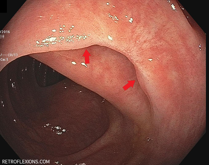 The excavated area between the two red arrows is a healed postpolypectomy scar.