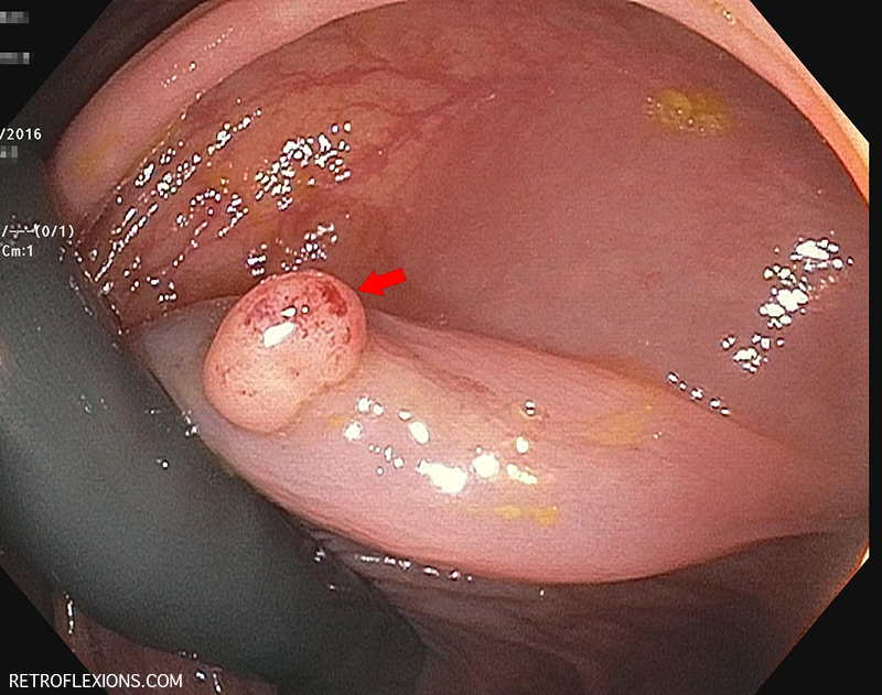 Retroflexed view in the ascending colon: Red arrow shows a polyp behind a fold. The lesion was injected with saline (prior to taking this picture), and then removed with a hot snare.
