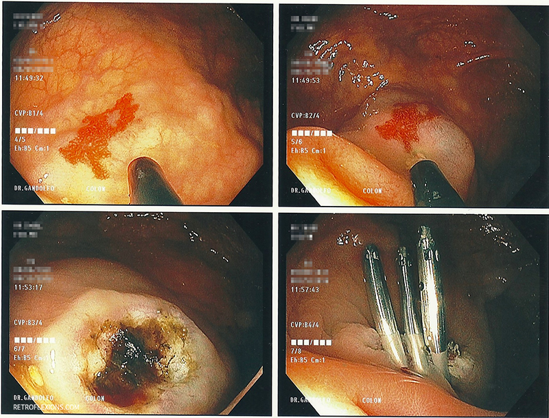 Treatment of cecal angiodysplasia with APC. The lesion is injected with saline (the ileocecal valve can be seen in the second picture). After injection, APC is used to ablate the lesion. A few clips were placed since the patient needed multiple blood-thinning agents.